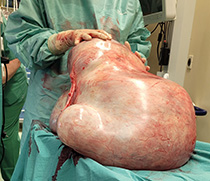 Der 32 Kilogramm schwere Tumor nach der Entfernung